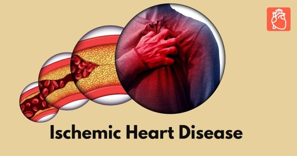 Ischemic Heart Diseases: Causes, Symptoms, Diagnosis, and Treatment